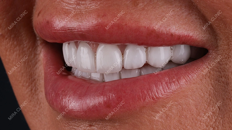 Hollywood smile seekers